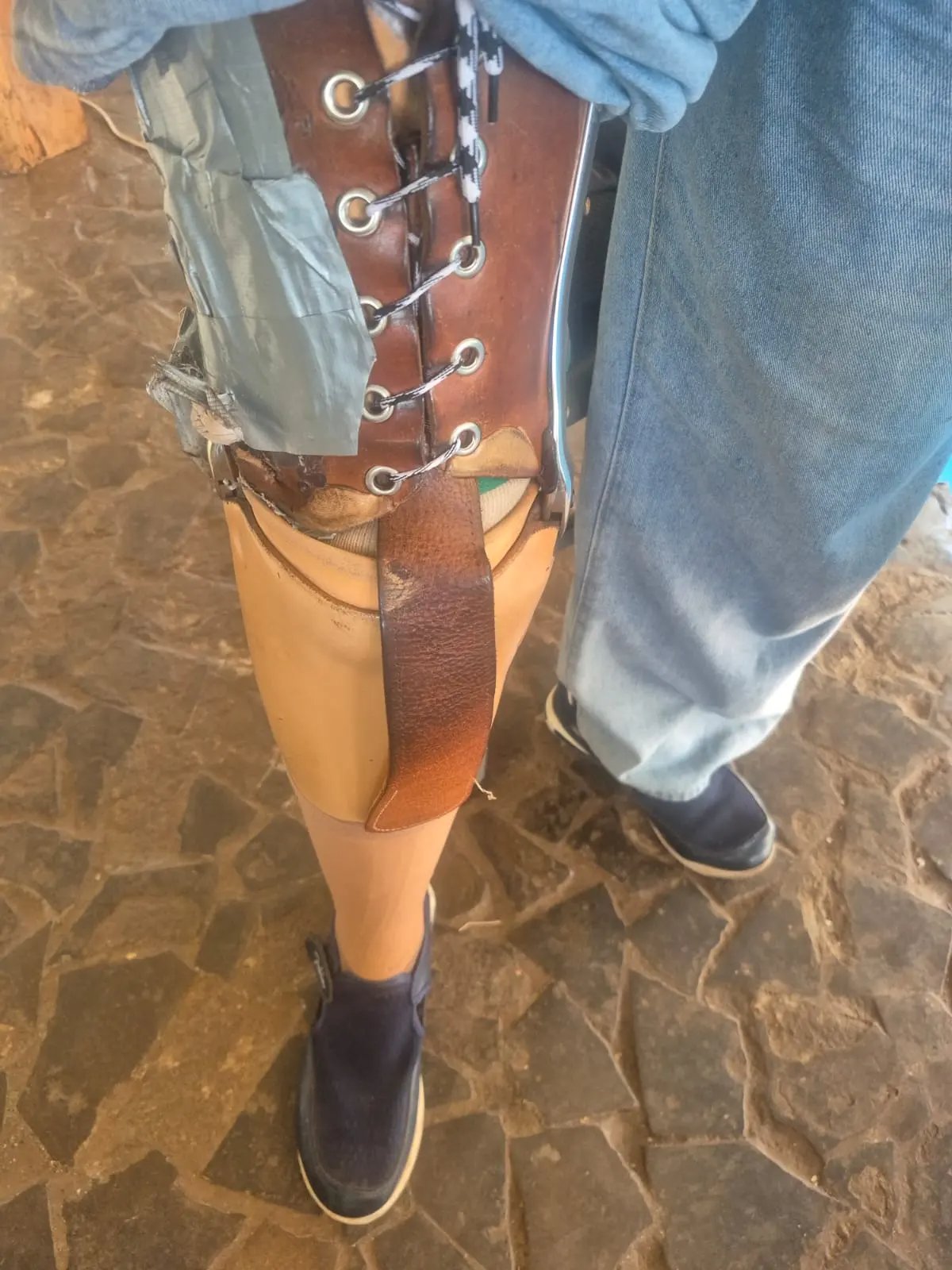 Broken prosthetic leg repaired with duct tape, showing lack of disability support on Easter Island